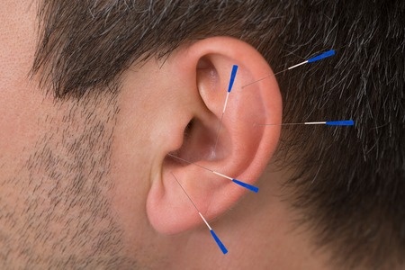 35462734 - close-up of acupuncture needles on man's ear