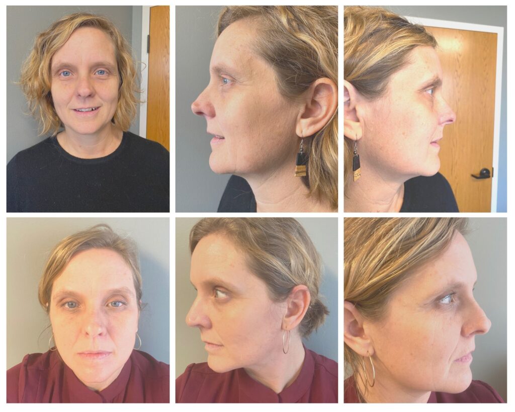 Facial Acupuncture Treatment